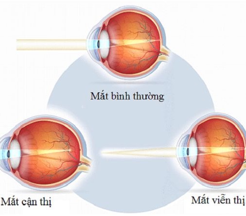 Tật cận thị và viễn thị, Cách khắc phục hiệu quả