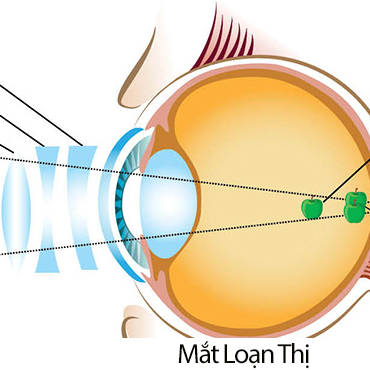 Thực Phẩm Tốt Cho Mắt Loạn Thị