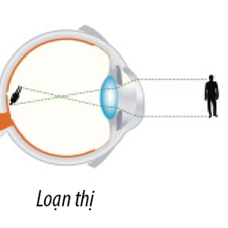 Cách Giảm Độ Loạn Thị Đơn Giản Ai Cũng Làm Được