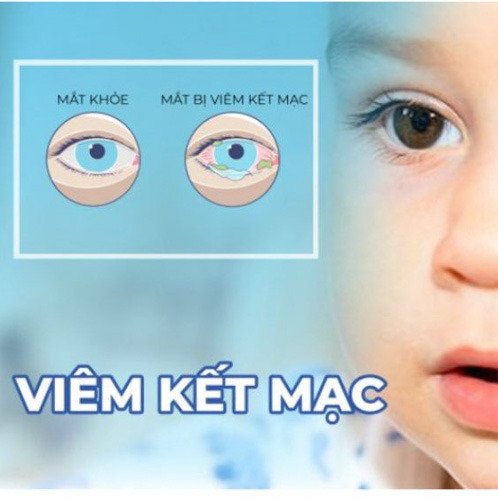 Viêm Kết Mạc: Nguyên Nhân, Triệu Chứng Và Cách Phòng Ngừa